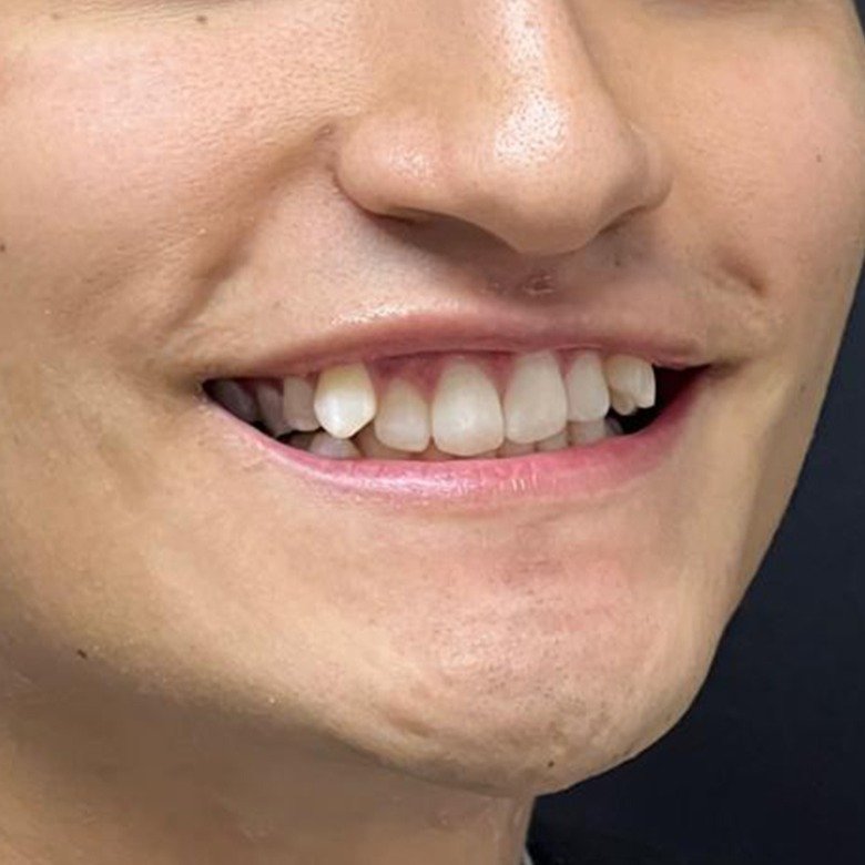 Sonrisa del paciente antes del tratamiento de ortodoncia