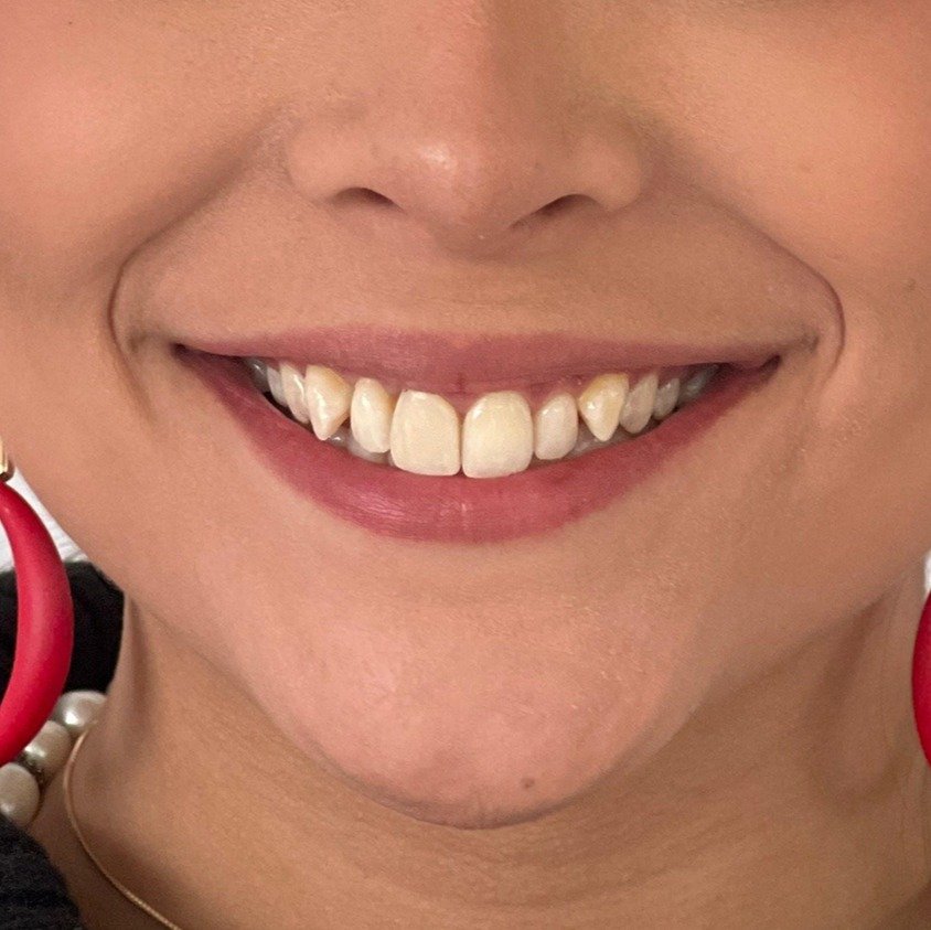 Sonrisa del paciente antes del tratamiento de ortodoncia